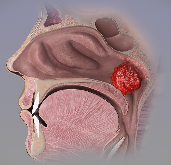 Hipertrofia de Adenoides